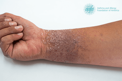 adult eczema