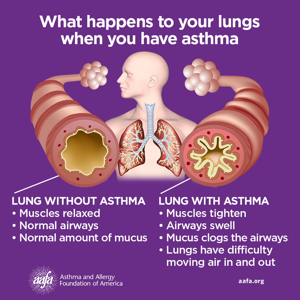 An image of an airway without asthma and another airway inflamed from asthma with a title that says, 