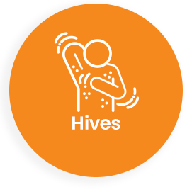 Hives